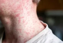 الولايات المتحدة تسجل أول حالتي وفاة بسبب الحصبة في 2026