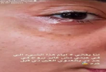 جوري بكر تكشف عن إصابتها بعدوى في عينها