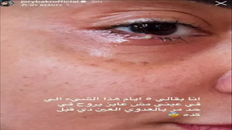 جوري بكر تكشف عن إصابتها بعدوى في عينها